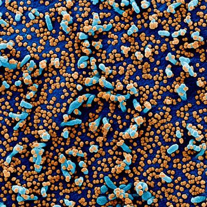 SARS-COV2 virus particles on human cells