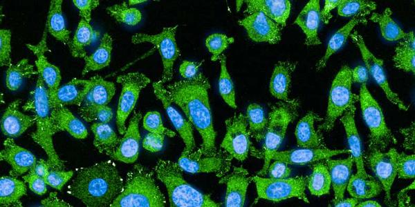lung cancer cells before treatment